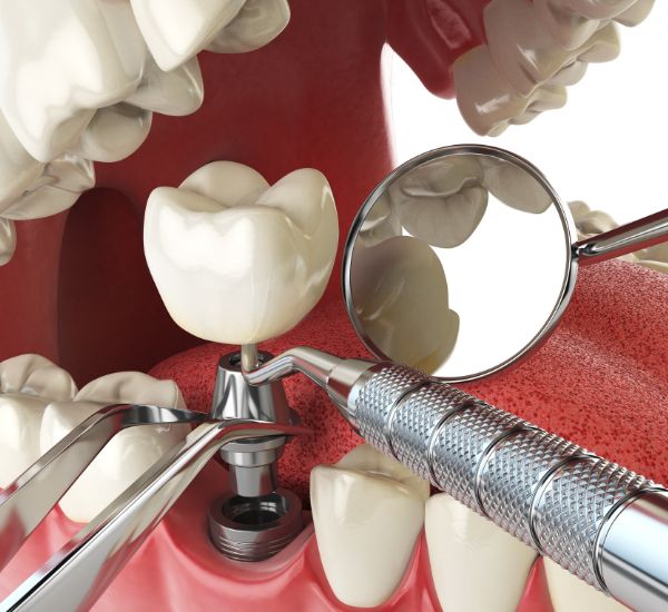 Implante Dentário - Ilustração